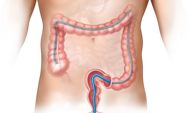 Я колоноскопии не боюсь - «Новости»