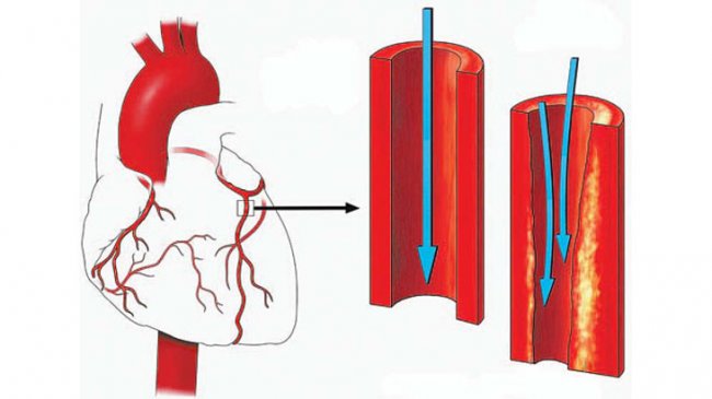 Все маски атеросклероза - «Новости»