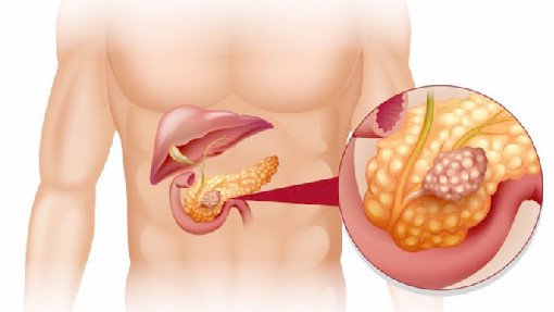 Врач раскрыл самую распространенную причину рака поджелудочной железы - «Новости Медицины»