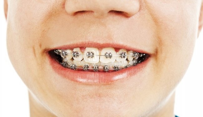 Коррекция прикуса у ребенка на каникулах – да или нет? - «Новости»