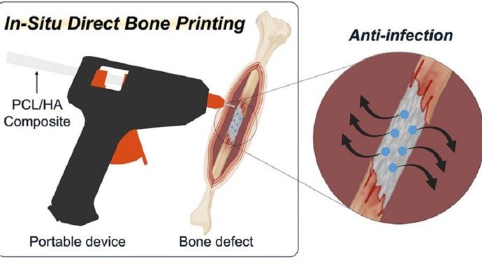 Переломы научились склеивать - «Новости Медицины»